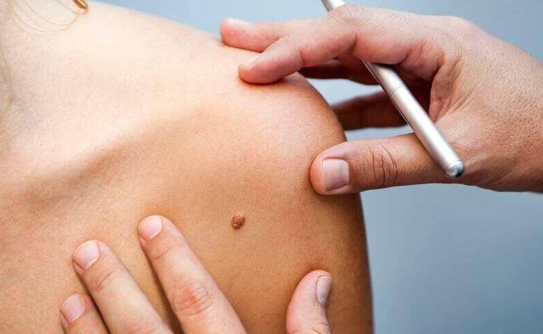 Узнайте о симптомах и методах лечения бородавок