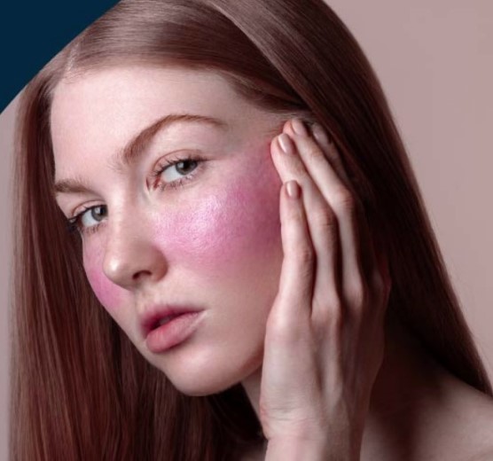 Как навсегда избавиться от розацеа?