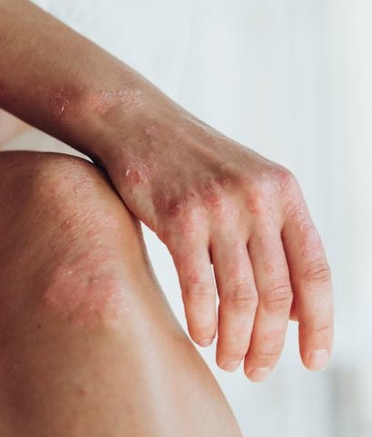 Как навсегда вылечить псориаз?